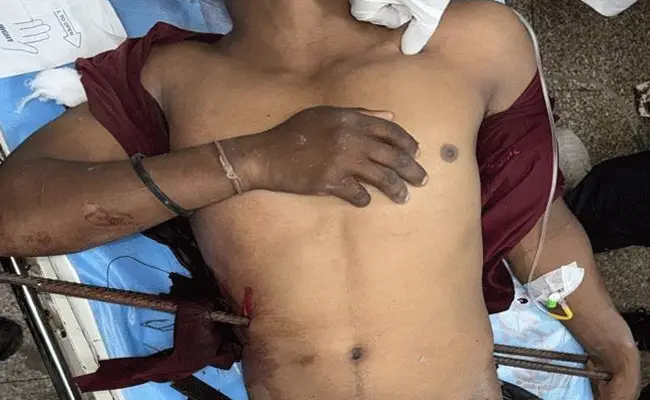25 वर्षीय युवा के शरीर में 12 एमएम के 3 लोहे के सरिए निकालने की जटिल सर्जरी एमवाय में सफल 25 वर्षीय युवा के शरीर में 12 एमएम के 3 लोहे के सरिए निकालने की जटिल सर्जरी एमवाय में सफल